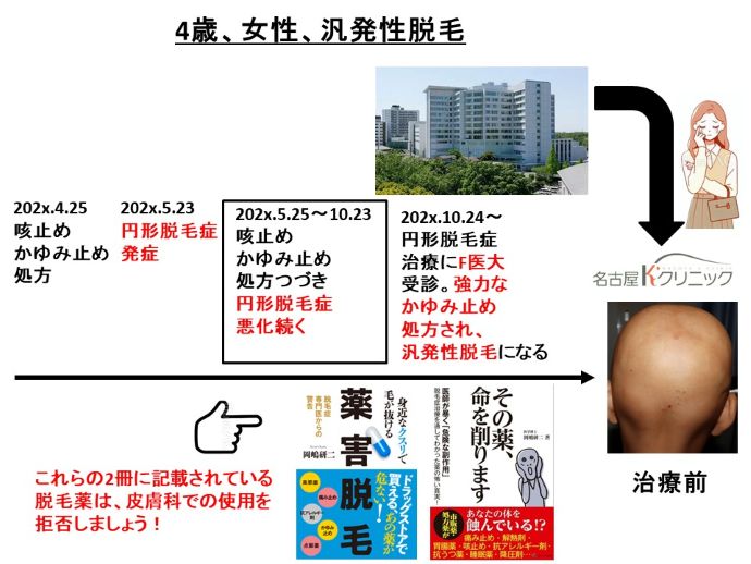 円形脱毛症　病院
